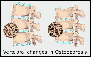 osteoporosis.gif